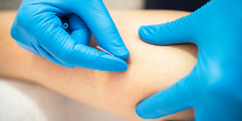 patient needing Weight Loss acupuncture in San Jose, CA