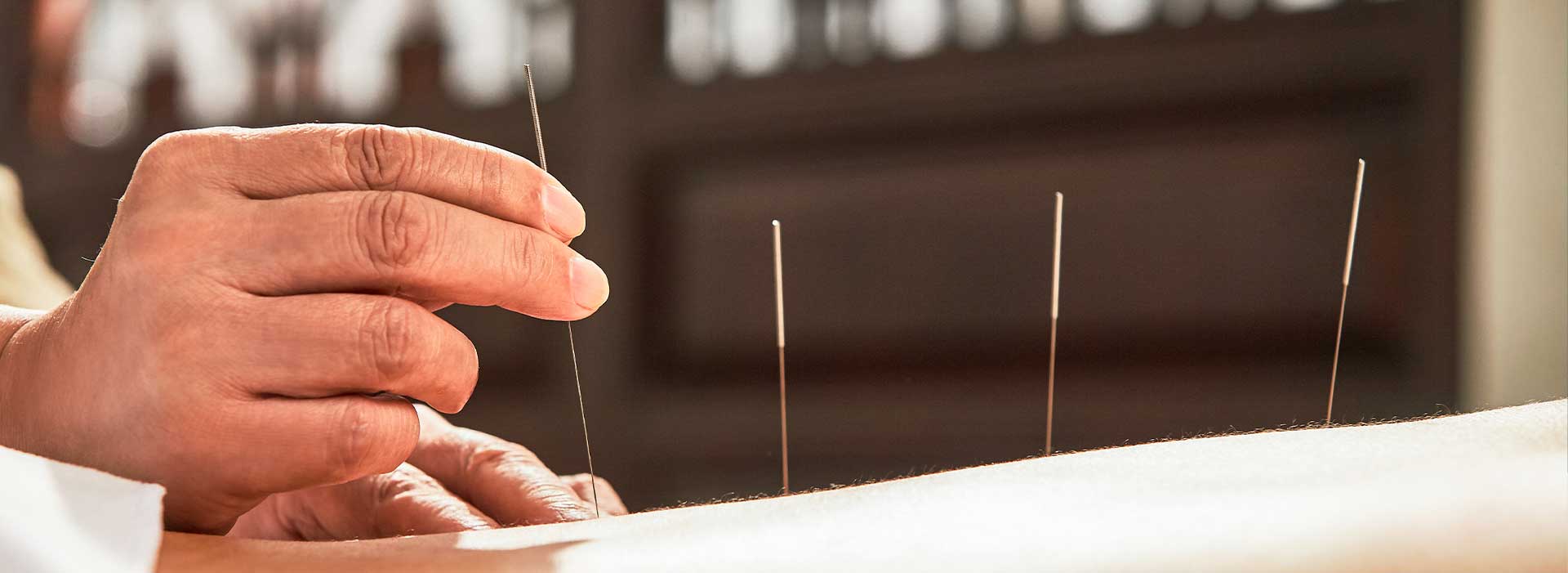 patient getting acupuncture in San Jose, CA