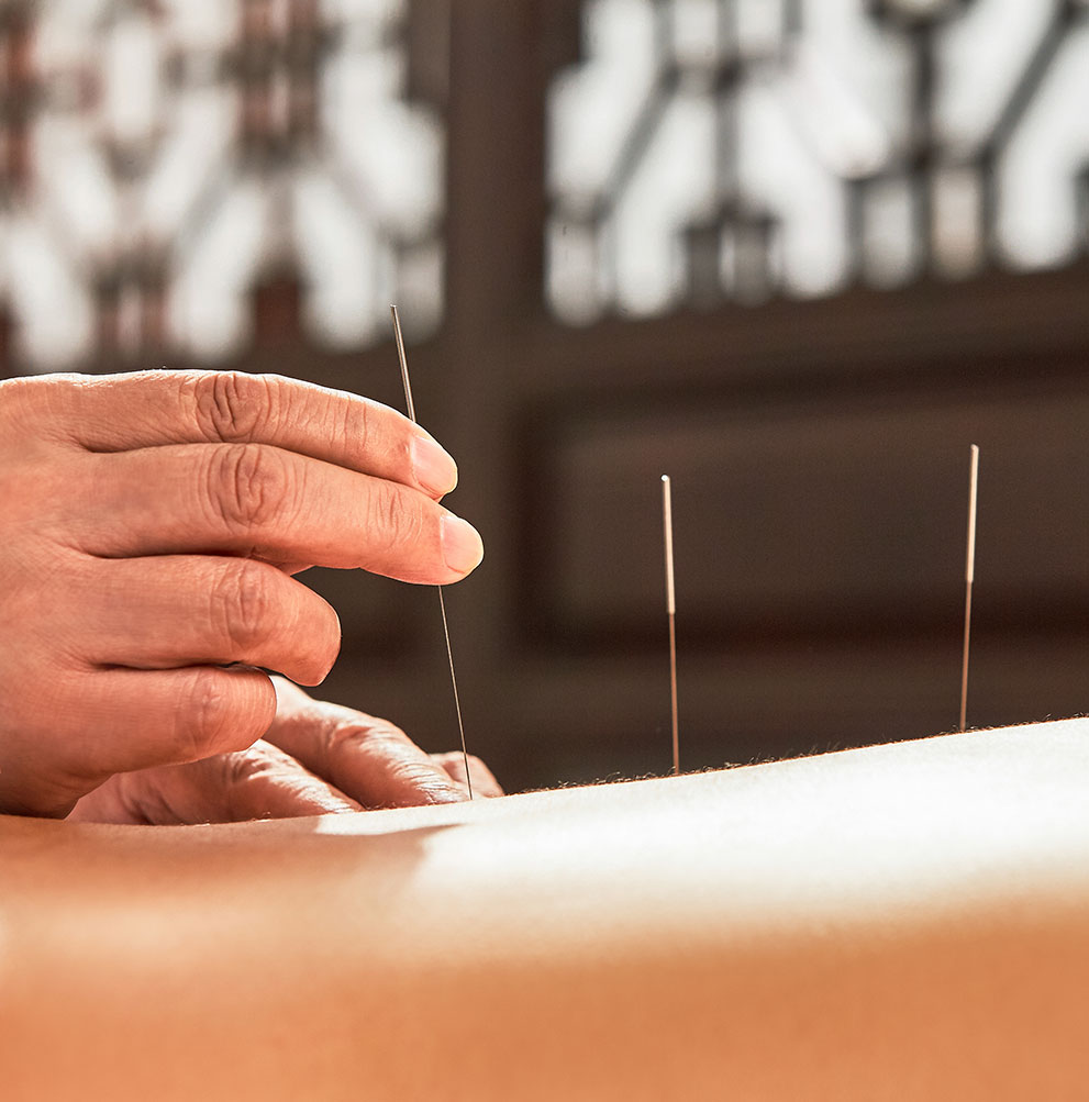 patient getting acupuncture in San Jose, CA