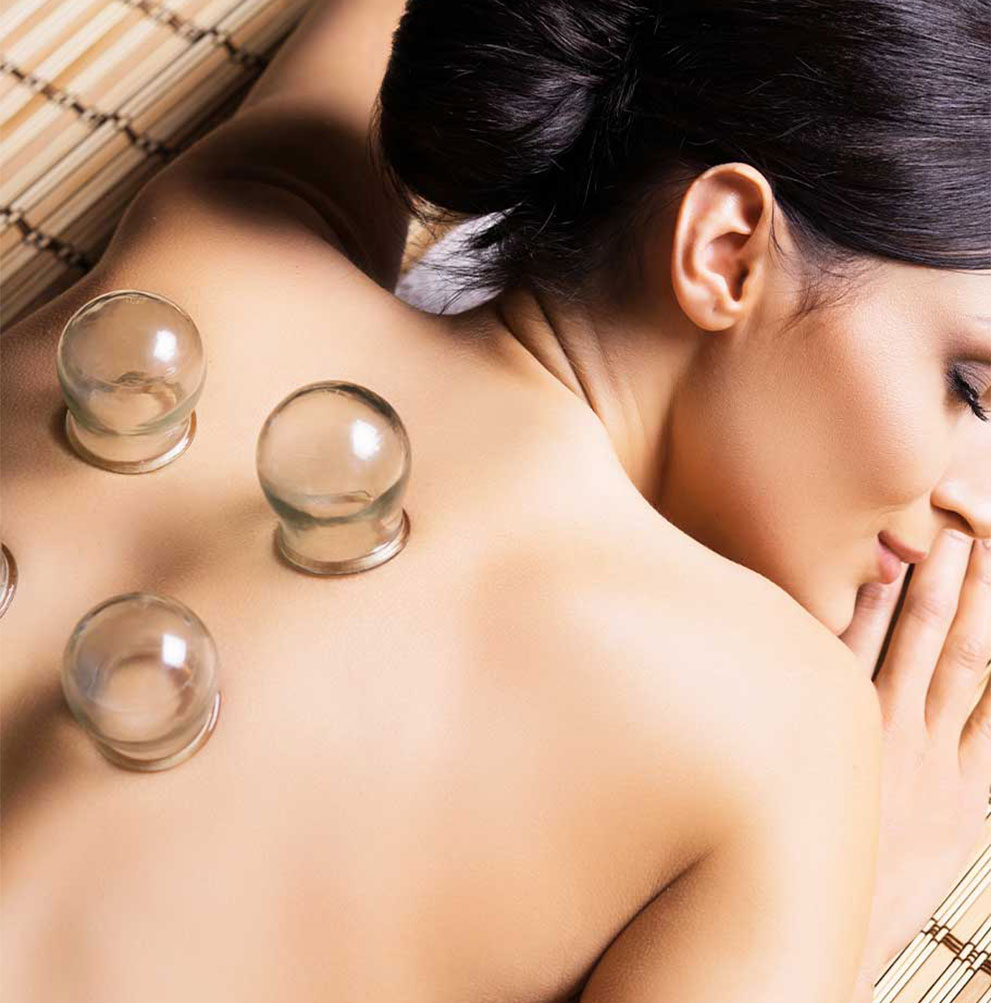 patient getting cupping therapy in San Jose, CA
