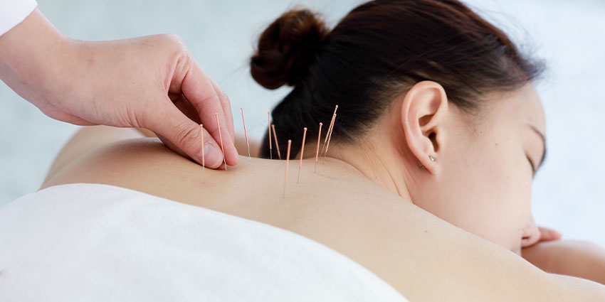 patient receiving acupuncture in San Jose