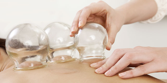 cupping therapy in San Jose, CA